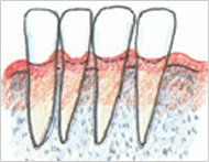 1 歯肉炎