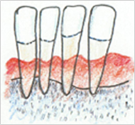 3 高度な歯周炎